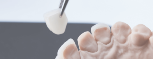 qué hacer si se despega una carilla dental