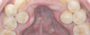 dientes supernumerarios
