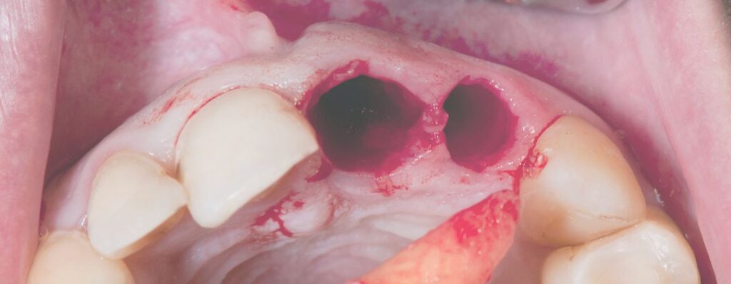 clinica dental oroa_alveolitis la complicación más frecuente tras una extracción dental
