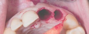 clinica dental oroa_alveolitis la complicación más frecuente tras una extracción dental