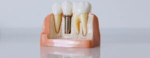 implantes de carga inmediata